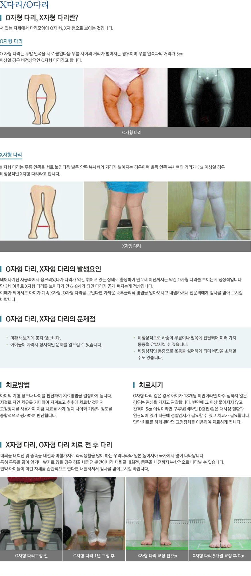 휜다리 교정