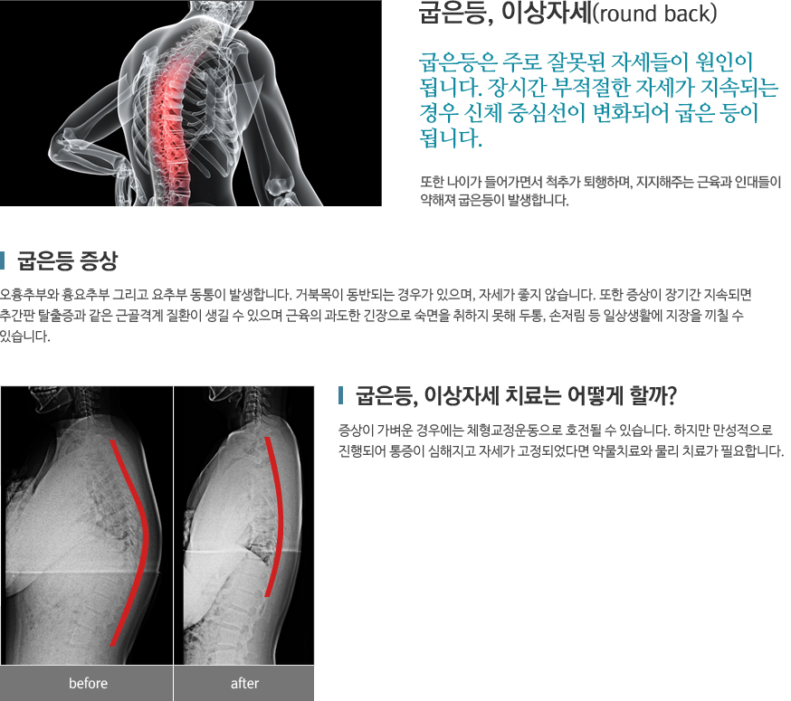 굽은등,이상자세